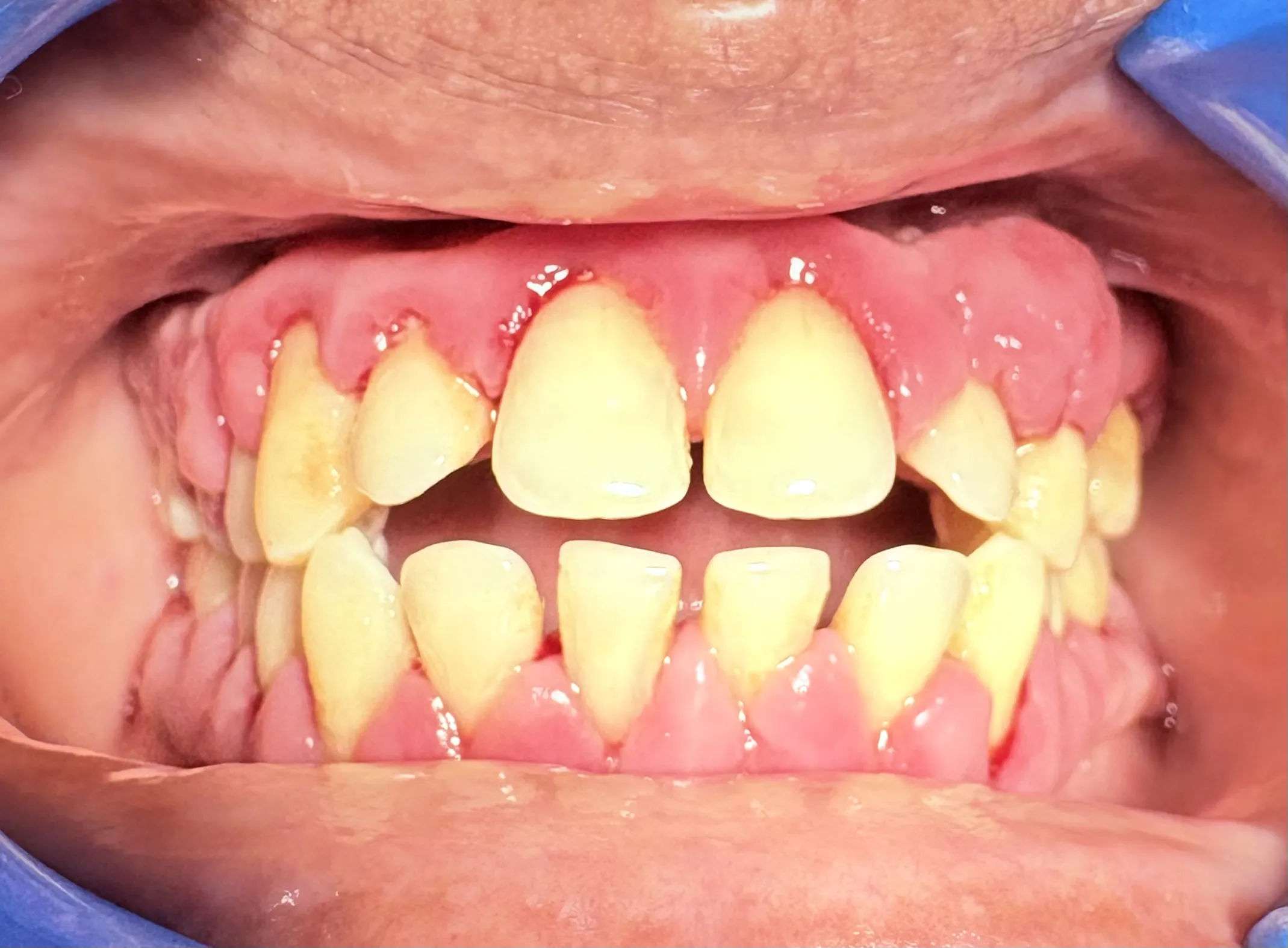 Gingival Enlargement Treatment  At Saket Dental Clinic & Hospital