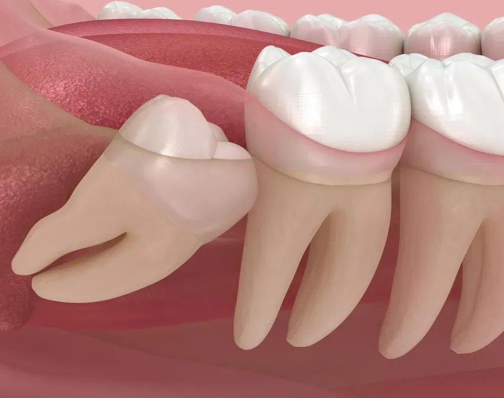 Wisdom Tooth Removal/IIIrd Molar